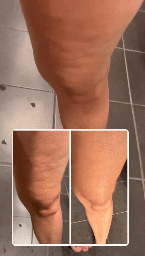 The Cellulite Smoother - Anti-Cellulite Massager