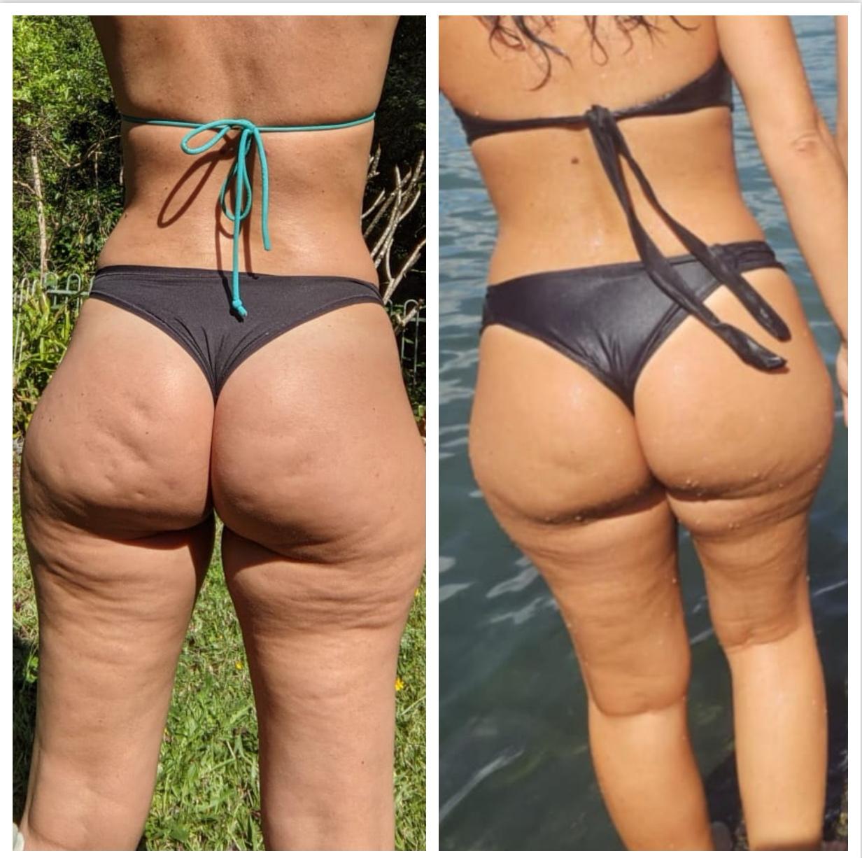 The Cellulite Smoother - Anti - Cellulite Massager - Cellulite Smoother