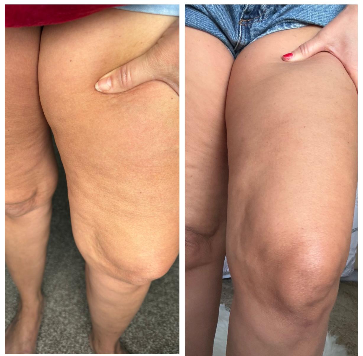 The Cellulite Smoother - Anti - Cellulite Massager - Cellulite Smoother