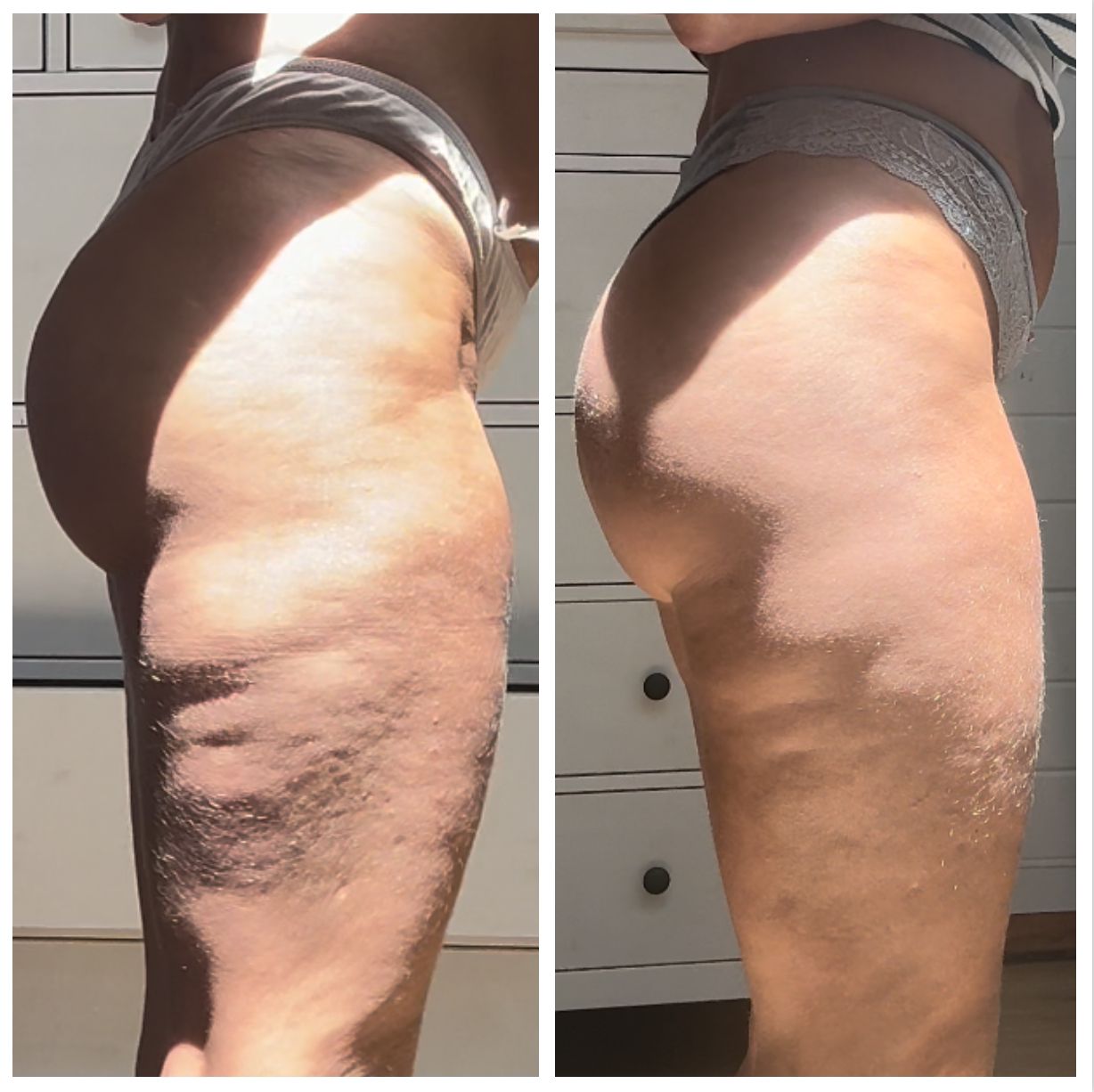 The Cellulite Smoother - Anti - Cellulite Massager - Cellulite Smoother